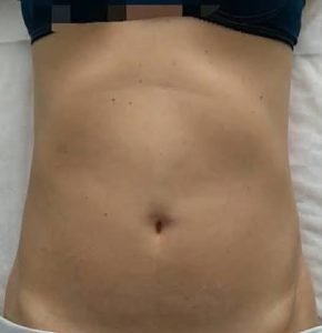 Before Lymphatic Drainage Massage